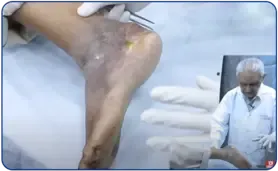 Non healing ulcers and the importance of undermining edges